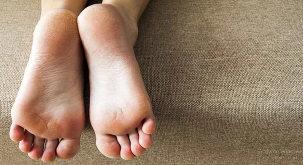 Cara Mengatasi Kaki Kering Pecah-pecah