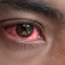 Cara Mengatasi Mata Merah Secara Alami